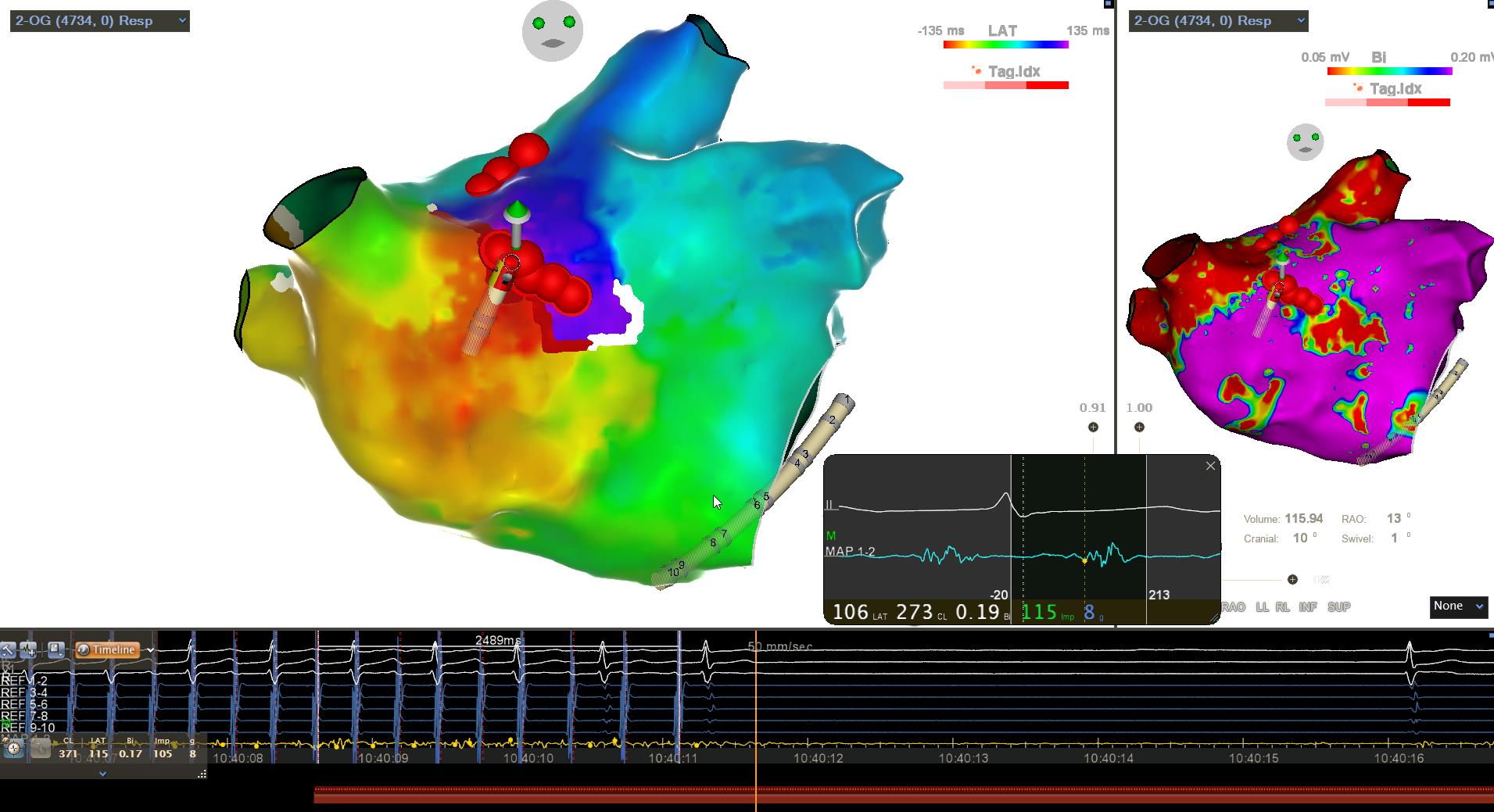 Dr franck Halimi, Left atrial flutter